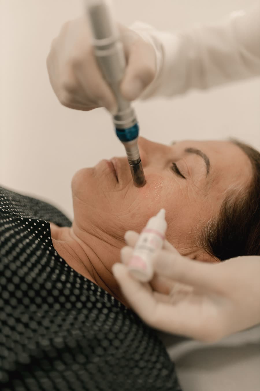 Microneedling-Behandlung